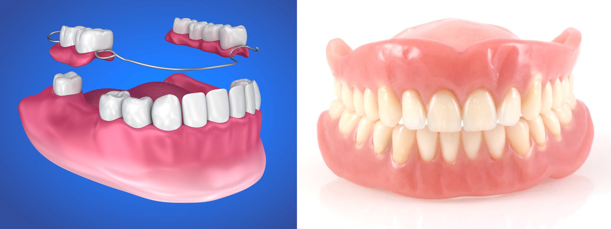 Partials and Dentures