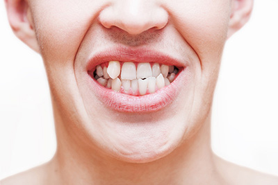 Straightening Misaligned Teeth