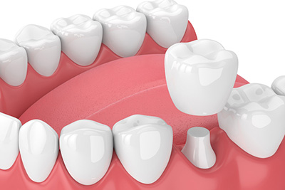 Dental Crowns: "Then" and "Now"