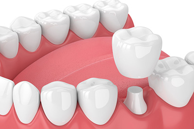Dental Crowns: "Then" and "Now" Dental Crowns: "Then" and "Now"
