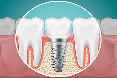 Dental Implants Dental Implants