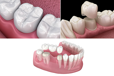 How Long Do Dental Crowns Usually Last?