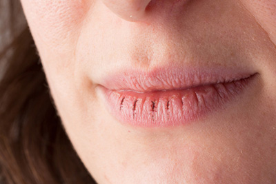 Do You Suffer with Dry Mouth? Do You Suffer with Dry Mouth?