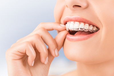 Everything You Need To Know About Invisalign “Invisible” Braces