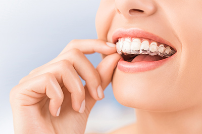 Everything You Need To Know About Invisalign “Invisible” Braces Everything You Need To Know About Invisalign “Invisible” Braces