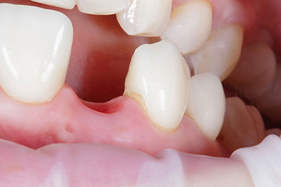 What Causes Gaps in Your Teeth?
