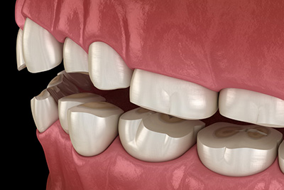 How to Determine if You’re Grinding Your Teeth and Why it’s Important to Stop How to Determine if You’re Grinding Your Teeth and Why it’s Important to Stop