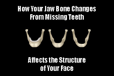 The Transformative Effects of Missing Teeth on Jaw Structure and Facial Contours