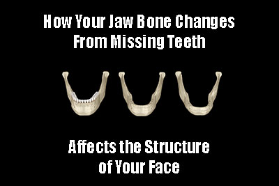 The Transformative Effects of Missing Teeth on Jaw Structure and Facial Contours The Transformative Effects of Missing Teeth on Jaw Structure and Facial Contours