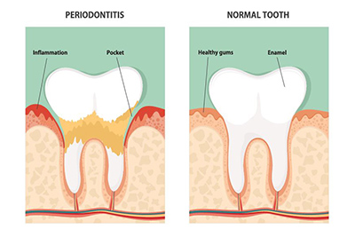 Stages of Periodontal Disease Stages of Periodontal Disease