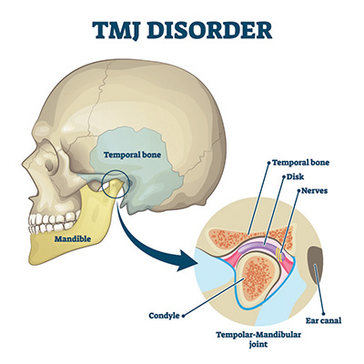 TMJ Disorder TMJ Disorder