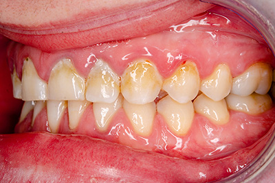 The Silent Saboteur: Unraveling the Mystery of Plaque and Its Impact on Your Oral Health The Silent Saboteur: Unraveling the Mystery of Plaque and Its Impact on Your Oral Health