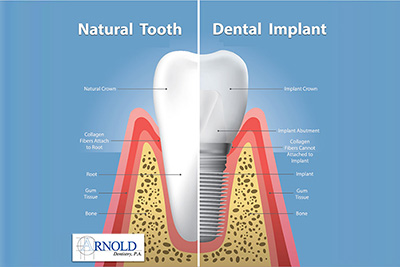 What are dental implants? What are the advantages of dental implants?