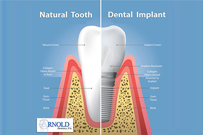 What are dental implants? What are the advantages of dental implants? What are dental implants? What are the advantages of dental implants?