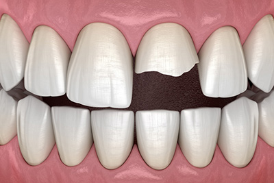 What To Do If You Ever Chip a Tooth What To Do If You Ever Chip a Tooth