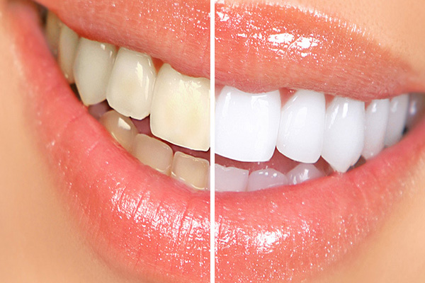 Cleaning and Whitening