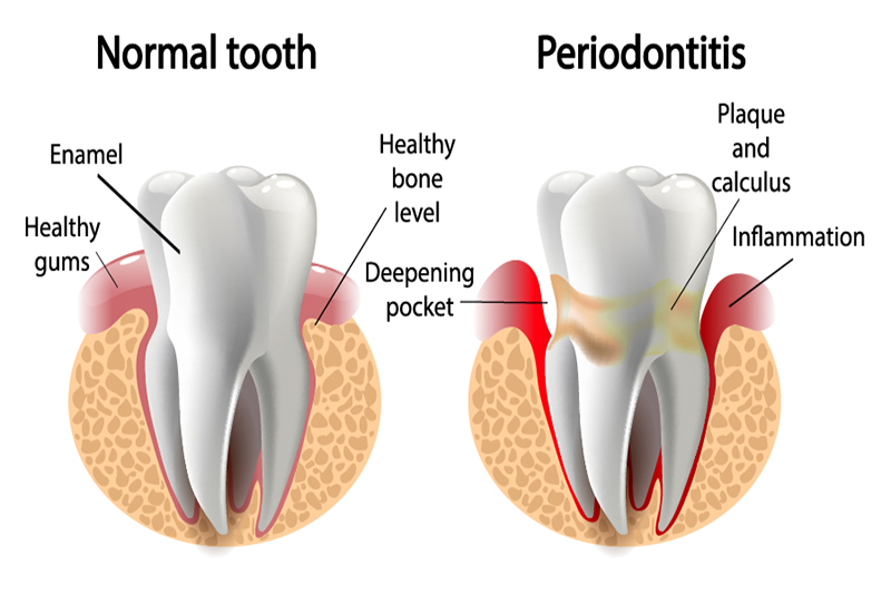 Periodontitis Periodontitis
